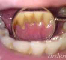 Откъде идват зъбите и зъбните плаки, как да се справят с тях? Какво е страшно от тартар и плака?…