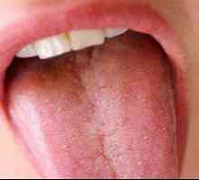 Възпаление на езика - глосит
